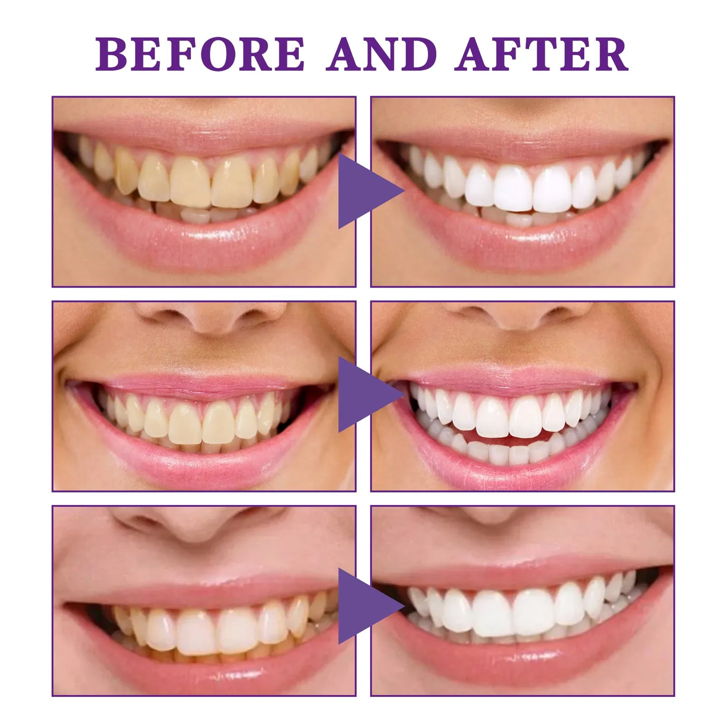 V34 Teeth Whitening Mousse – Whiten, Freshen & Protect Daily